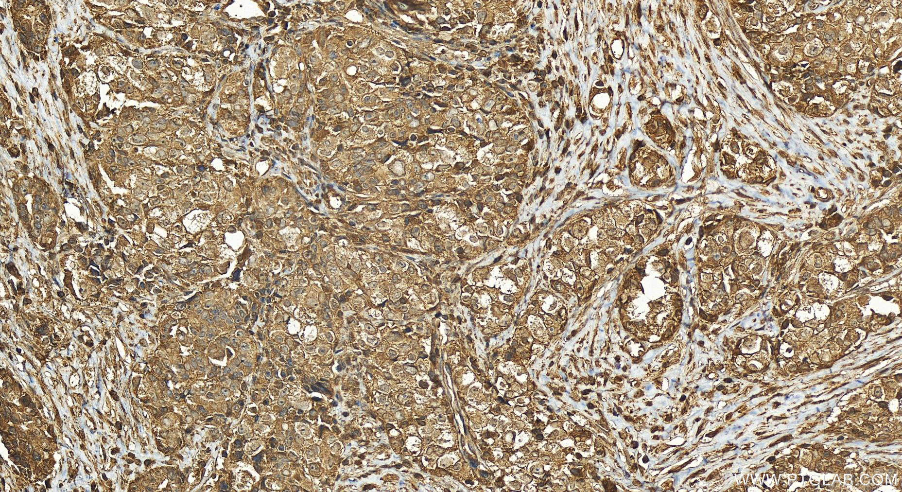 Immunohistochemistry (IHC) staining of human ovary cancer tissue using GMIP Polyclonal antibody (25917-1-AP)