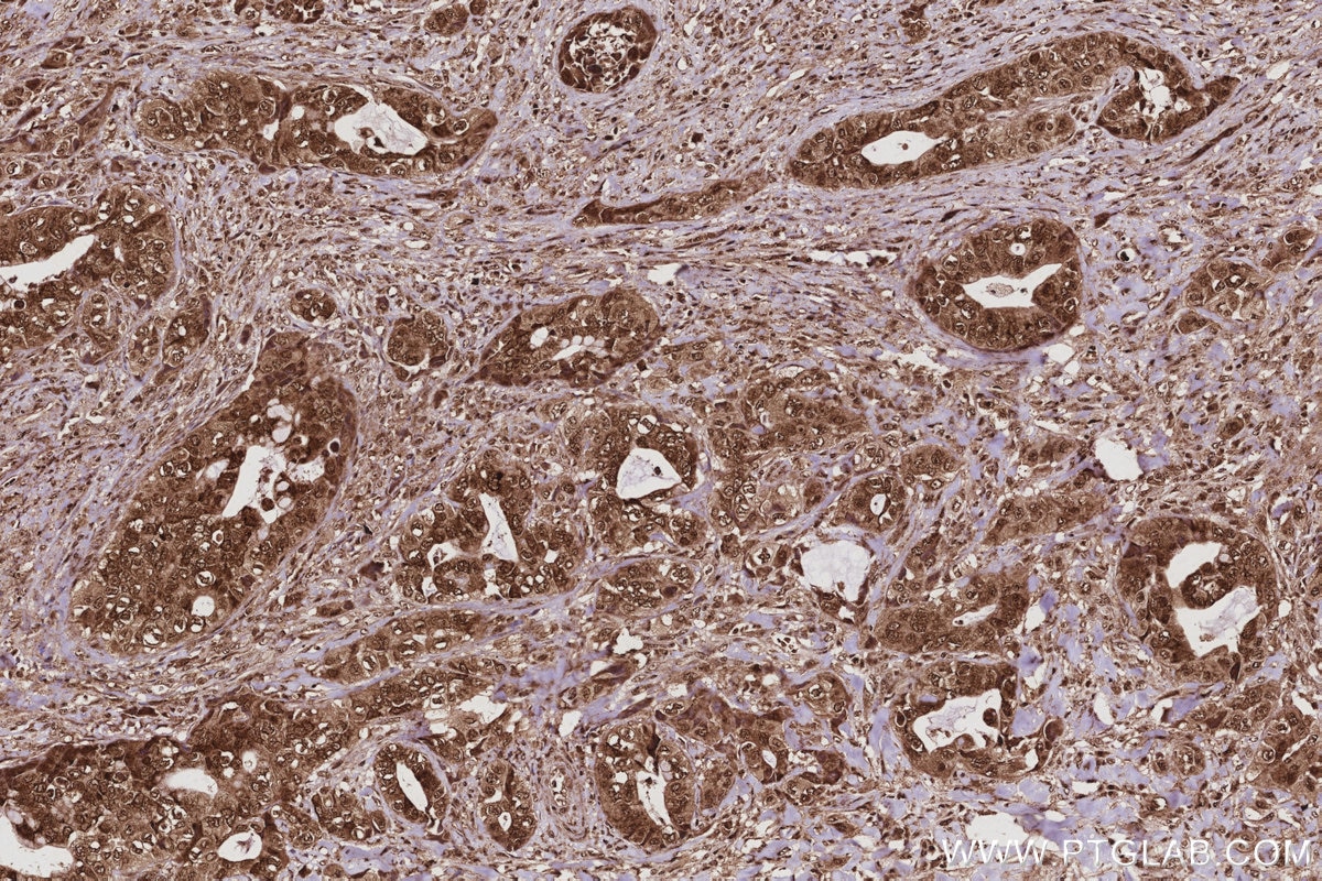 Immunohistochemistry (IHC) staining of human pancreas cancer tissue using GMIP Recombinant monoclonal antibody (86101-2-RR)