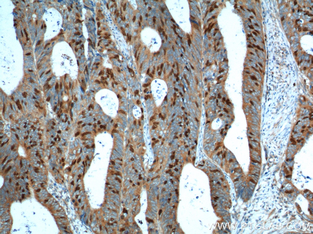 Immunohistochemistry (IHC) staining of human colon cancer tissue using Geminin Polyclonal antibody (10802-1-AP)