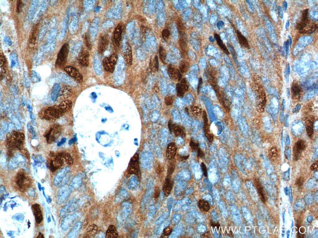 Immunohistochemistry (IHC) staining of human colon cancer tissue using Geminin Polyclonal antibody (10802-1-AP)