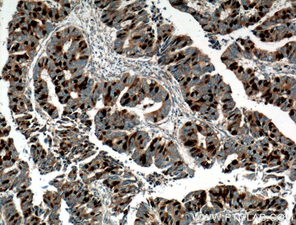 Immunohistochemistry (IHC) staining of human colon cancer tissue using Geminin Polyclonal antibody (10802-1-AP)