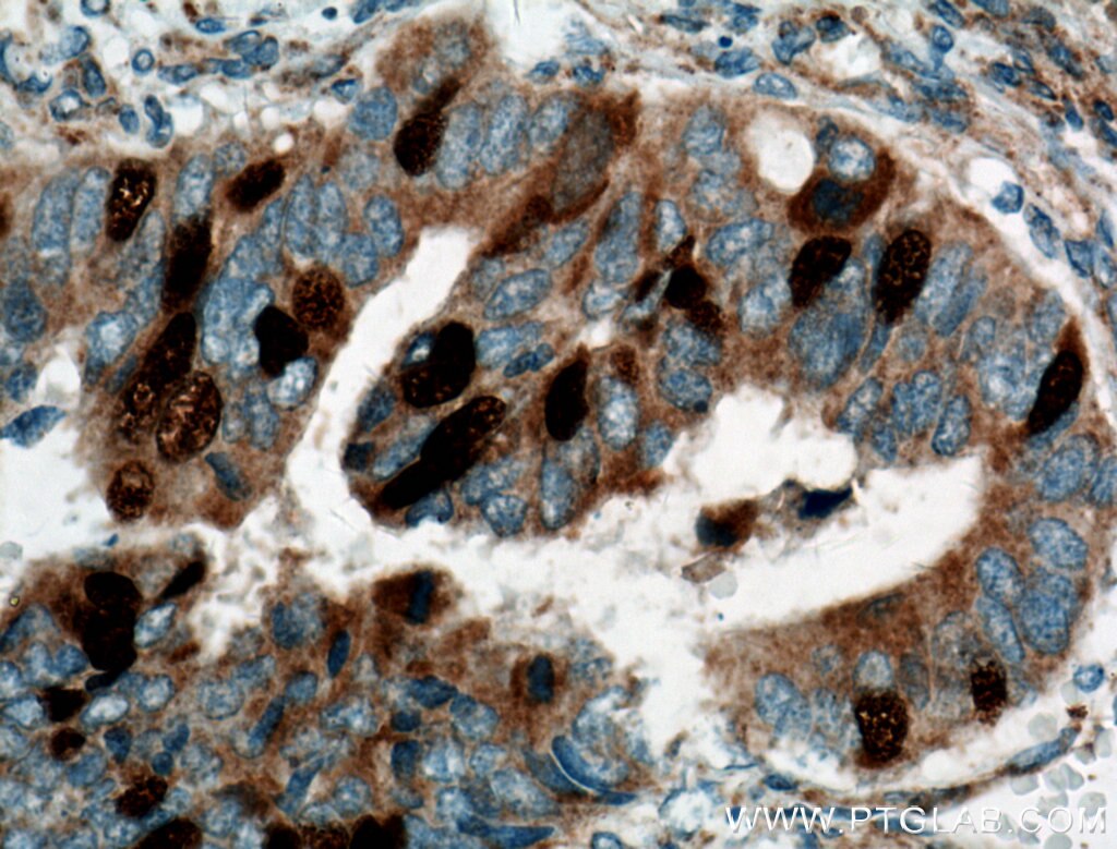 Immunohistochemistry (IHC) staining of human colon cancer tissue using Geminin Polyclonal antibody (10802-1-AP)