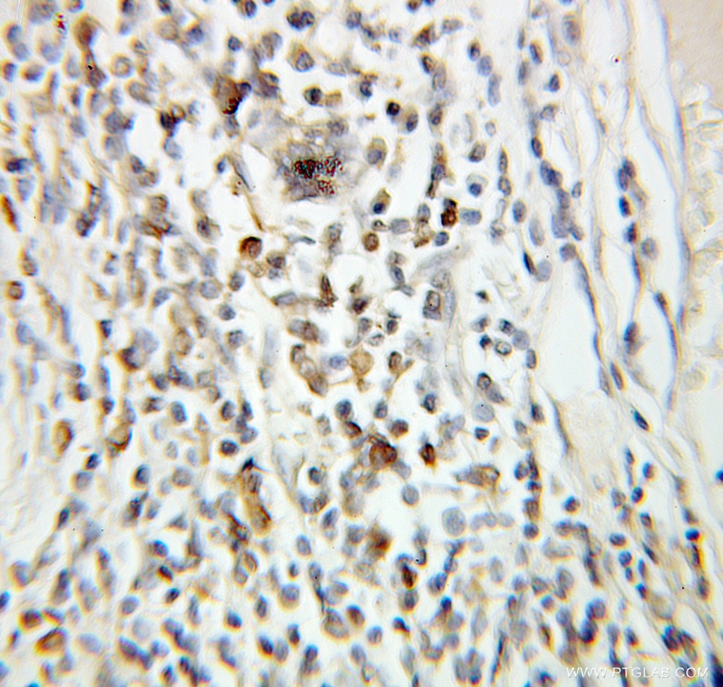 Immunohistochemistry (IHC) staining of human breast cancer tissue using Geminin Polyclonal antibody (10802-1-AP)