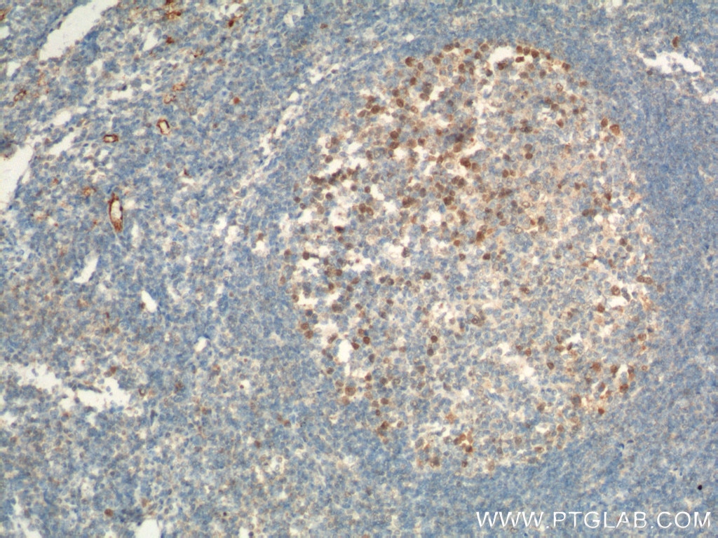 Immunohistochemistry (IHC) staining of human tonsillitis tissue using GMNN Monoclonal antibody (66566-1-Ig)