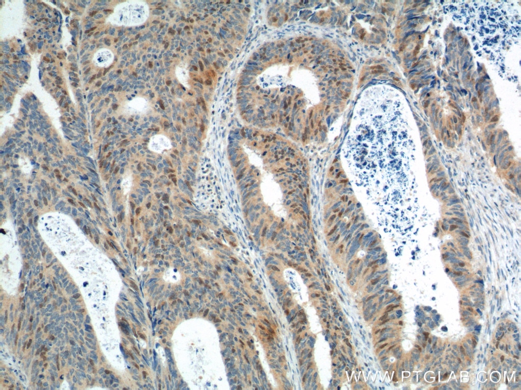 Immunohistochemistry (IHC) staining of human colon cancer tissue using GMNN Monoclonal antibody (66566-1-Ig)