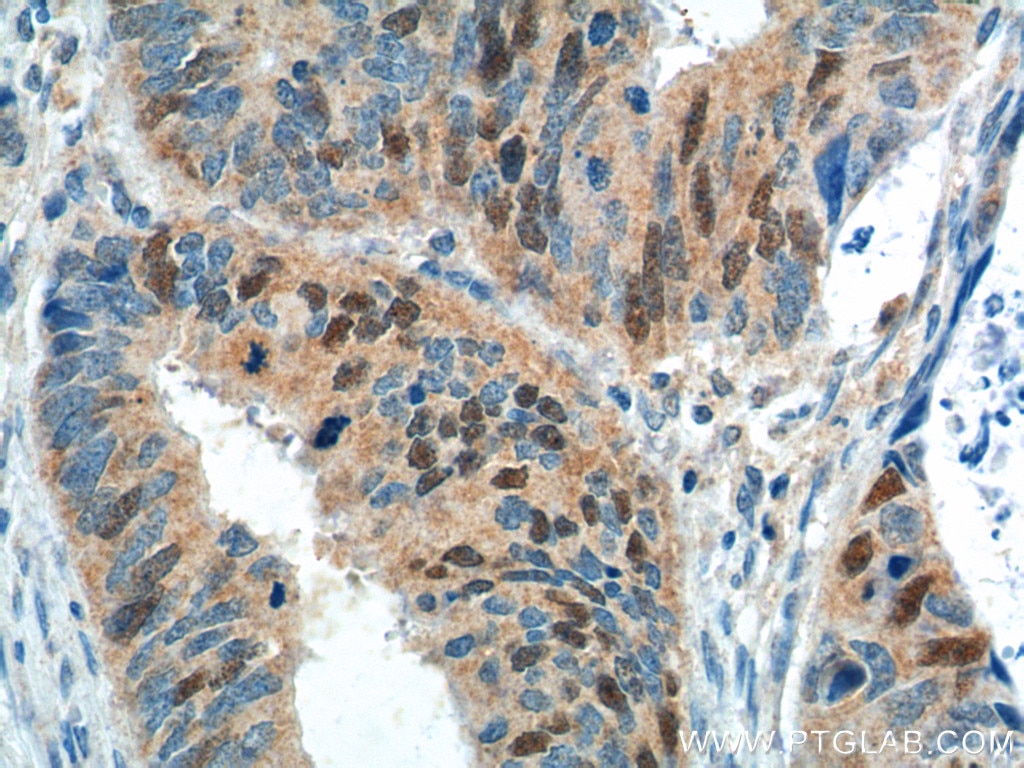 Immunohistochemistry (IHC) staining of human colon cancer tissue using GMNN Monoclonal antibody (66566-1-Ig)