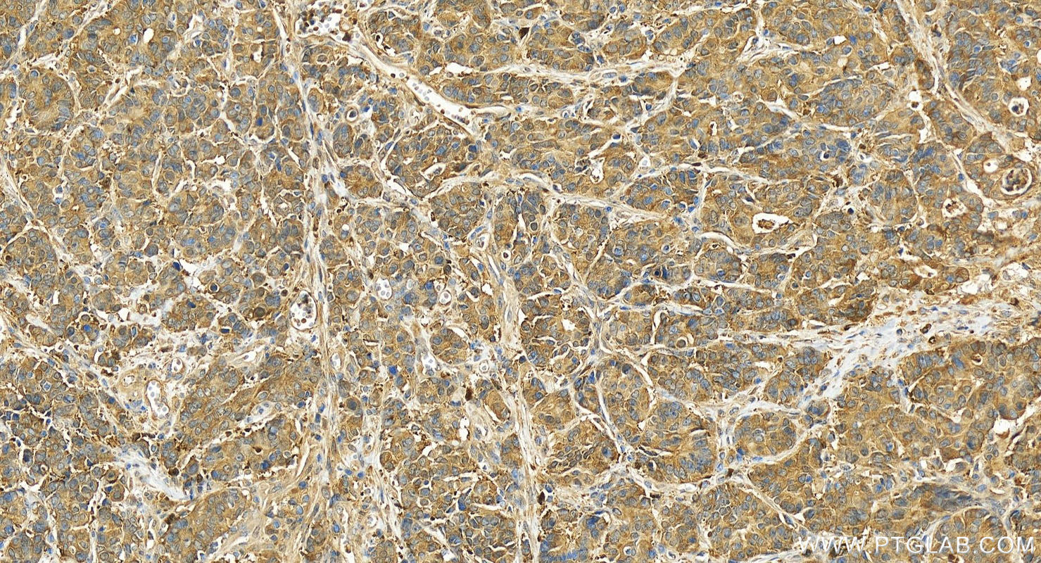 Immunohistochemistry (IHC) staining of human stomach cancer tissue using GMPPA Polyclonal antibody (15517-1-AP)