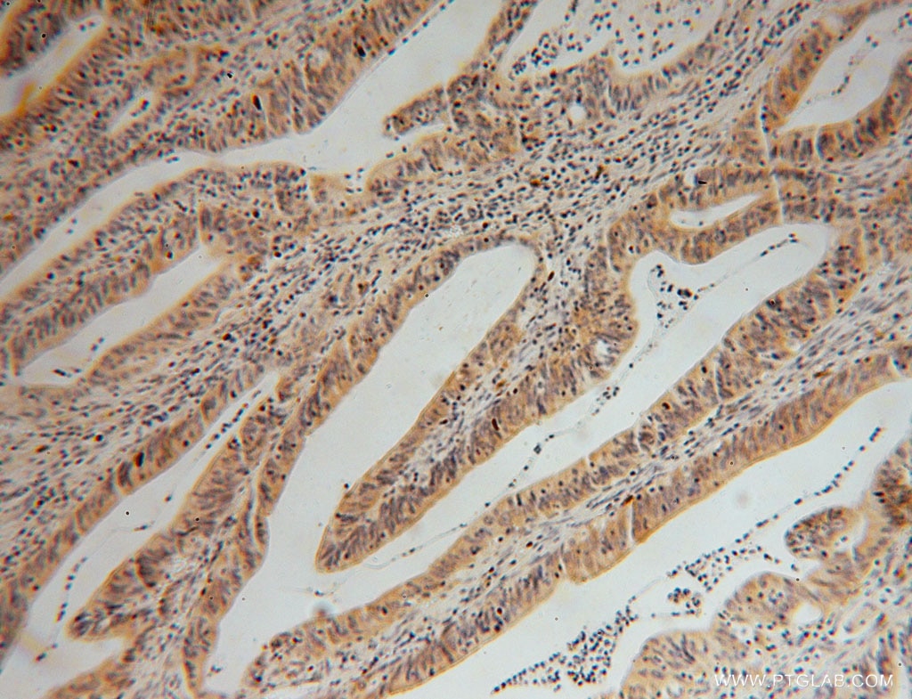 Immunohistochemistry (IHC) staining of human colon cancer tissue using GMPR 1/2 Polyclonal antibody (15683-1-AP)