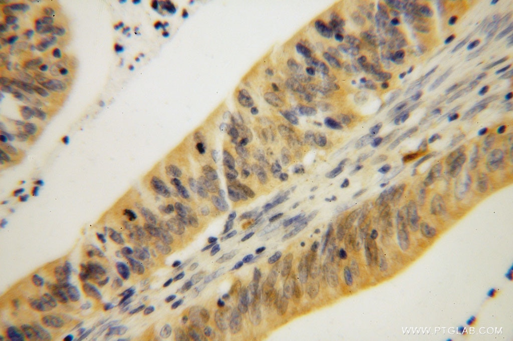 Immunohistochemistry (IHC) staining of human colon cancer tissue using GMPR 1/2 Polyclonal antibody (15683-1-AP)