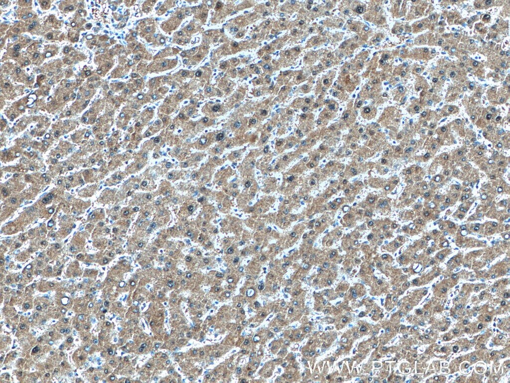 Immunohistochemistry (IHC) staining of human liver cancer tissue using GMPS Polyclonal antibody (16376-1-AP)