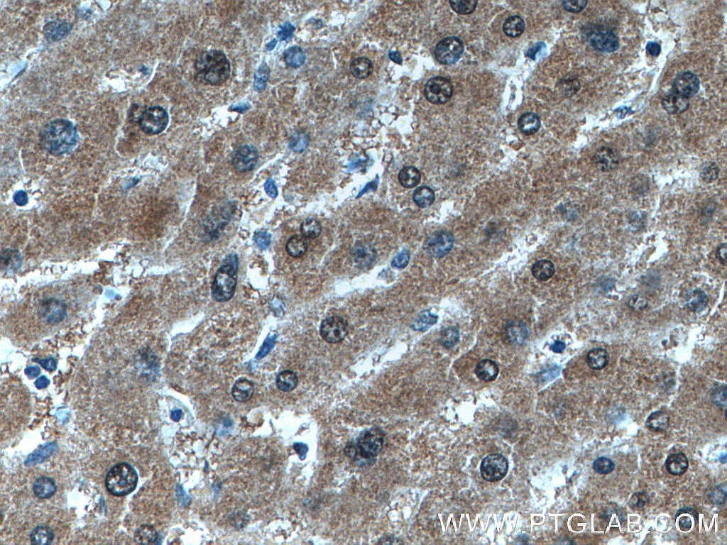 Immunohistochemistry (IHC) staining of human liver cancer tissue using GMPS Polyclonal antibody (16376-1-AP)