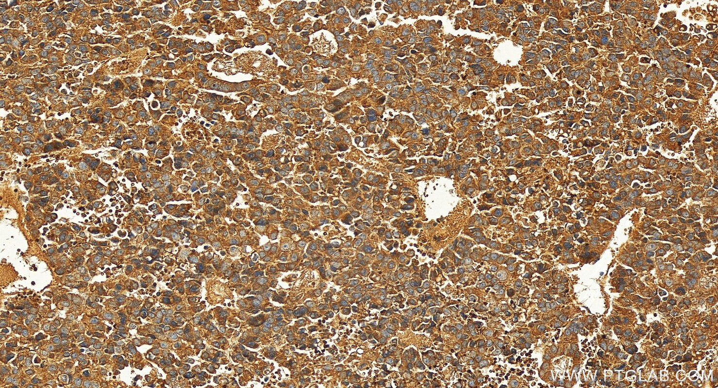 Immunohistochemistry (IHC) staining of human hepatocellular cancer using GNA12 Polyclonal antibody (31431-1-AP)