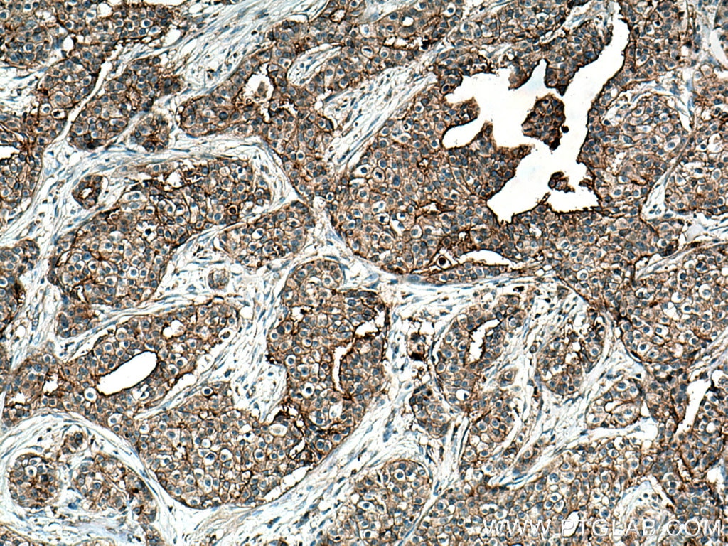 Immunohistochemistry (IHC) staining of human breast cancer tissue using GNA13 Monoclonal antibody (67188-1-Ig)