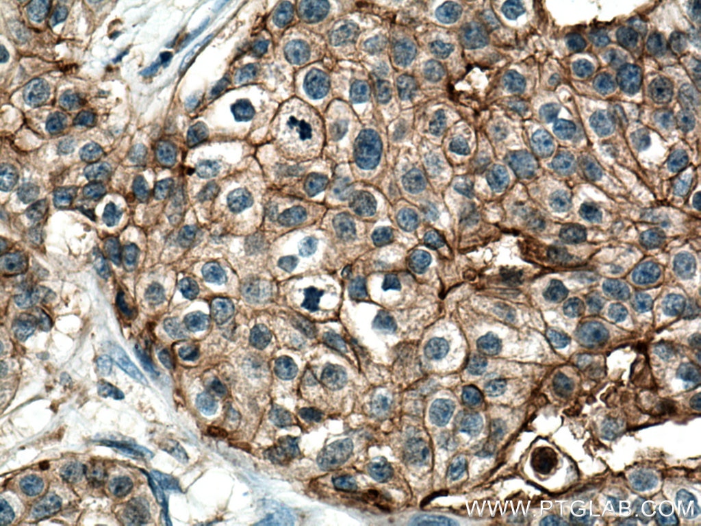 Immunohistochemistry (IHC) staining of human breast cancer tissue using GNA13 Monoclonal antibody (67188-1-Ig)