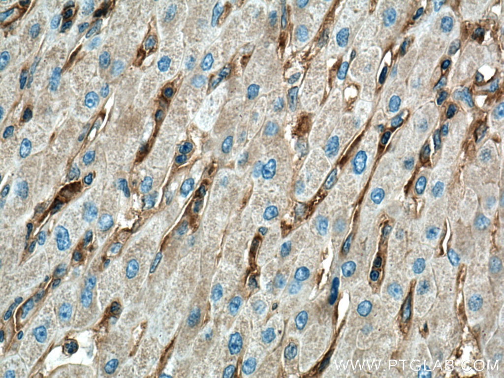 Immunohistochemistry (IHC) staining of human liver cancer tissue using GNA13 Monoclonal antibody (67188-1-Ig)