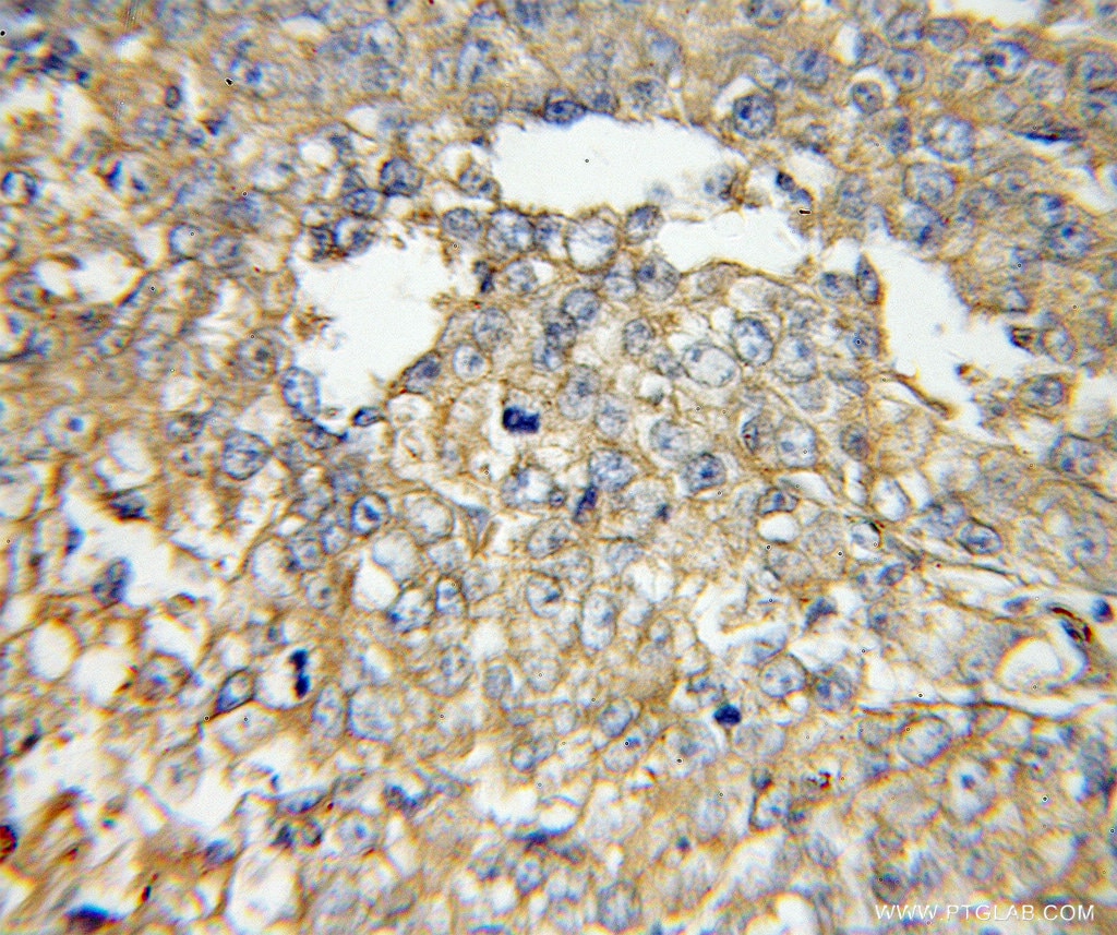 Immunohistochemistry (IHC) staining of human lung cancer tissue using GNAI2 Polyclonal antibody (11136-1-AP)