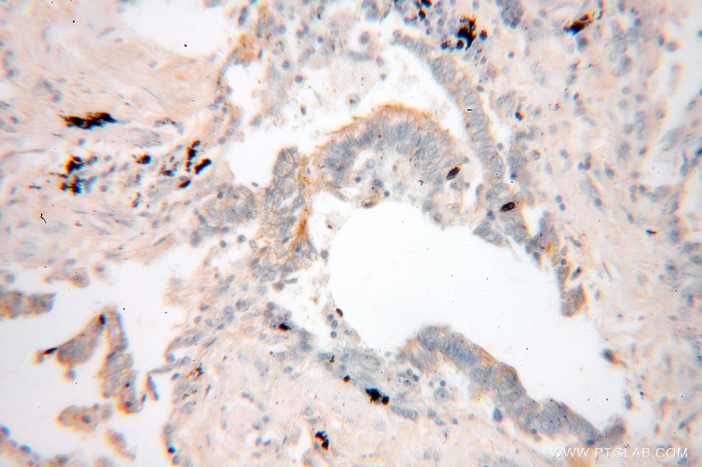 Immunohistochemistry (IHC) staining of human lung cancer tissue using GNAI2 Polyclonal antibody (11136-1-AP)