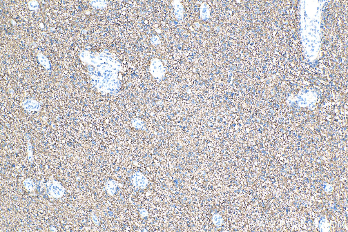 IHC staining of human gliomas using 12635-1-AP