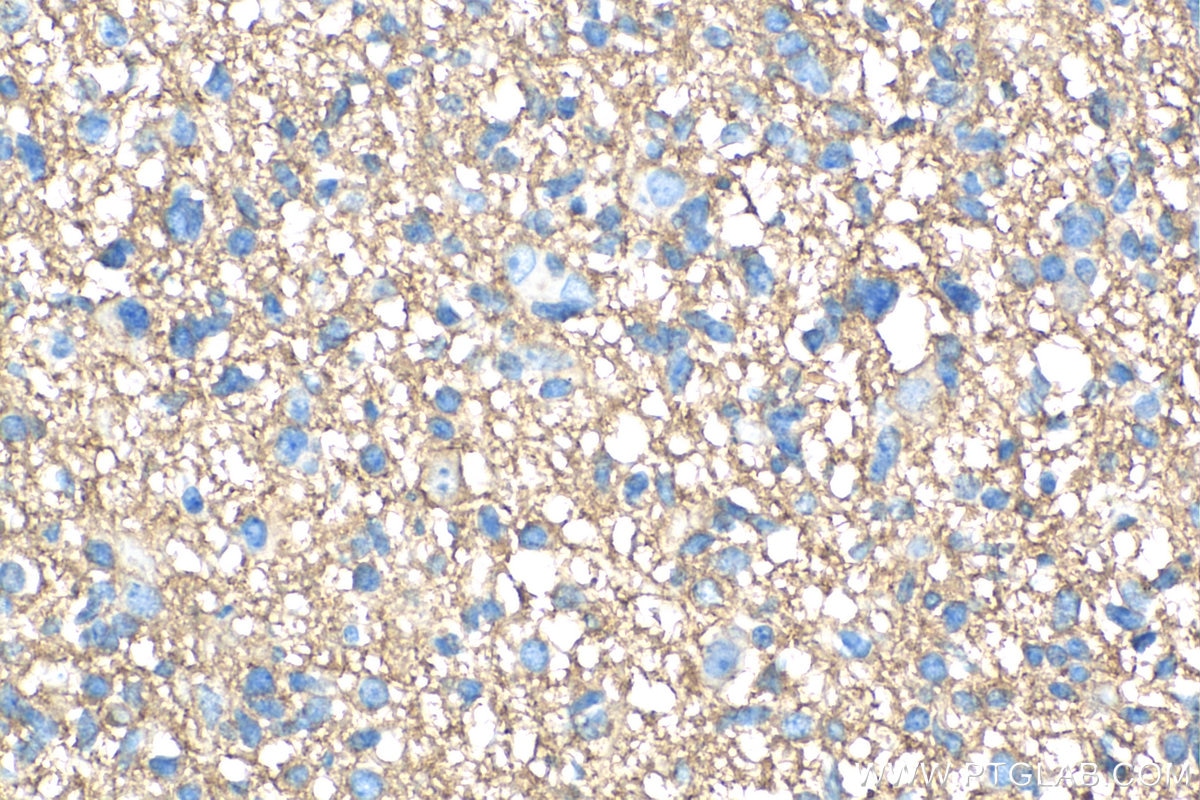 Immunohistochemistry (IHC) staining of human gliomas tissue using GNAO1 Polyclonal antibody (12635-1-AP)