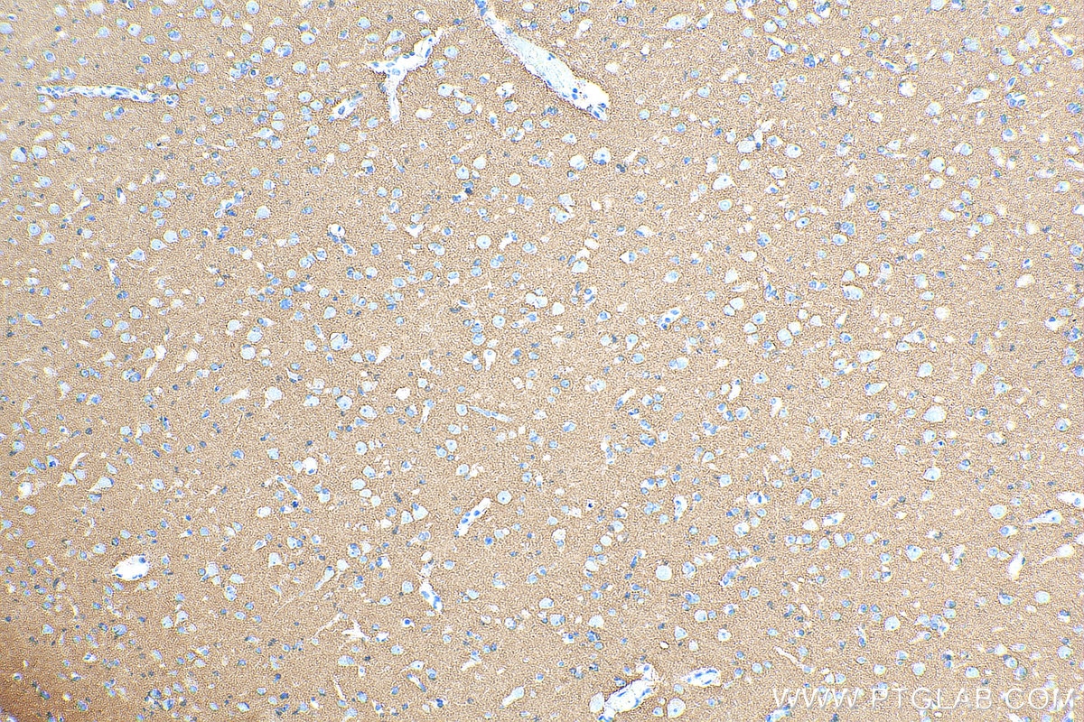 Immunohistochemistry (IHC) staining of human gliomas tissue using GNAO1 Polyclonal antibody (12635-1-AP)