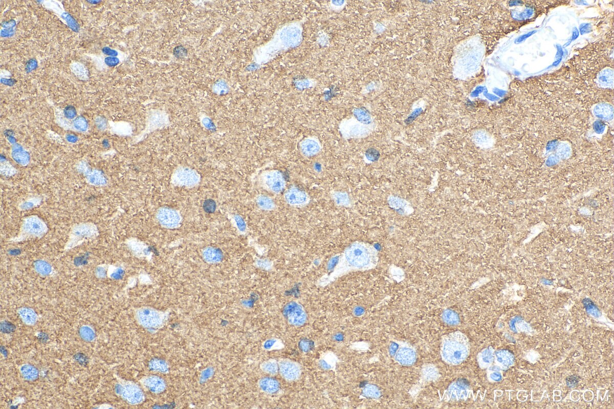 IHC staining of human gliomas using 12635-1-AP