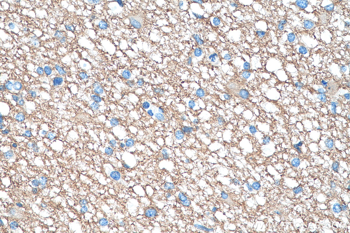 Immunohistochemistry (IHC) staining of human gliomas tissue using GNAO1 Monoclonal antibody (68027-1-Ig)