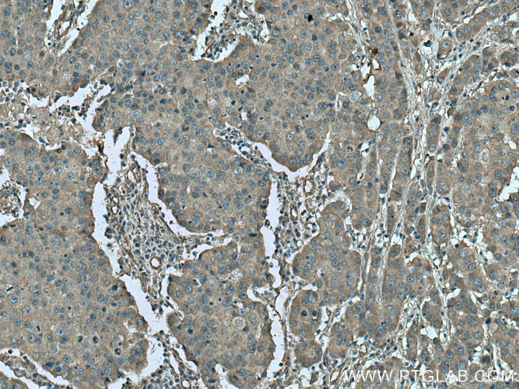 Immunohistochemistry (IHC) staining of human breast cancer tissue using GNAQ Polyclonal antibody (13927-1-AP)