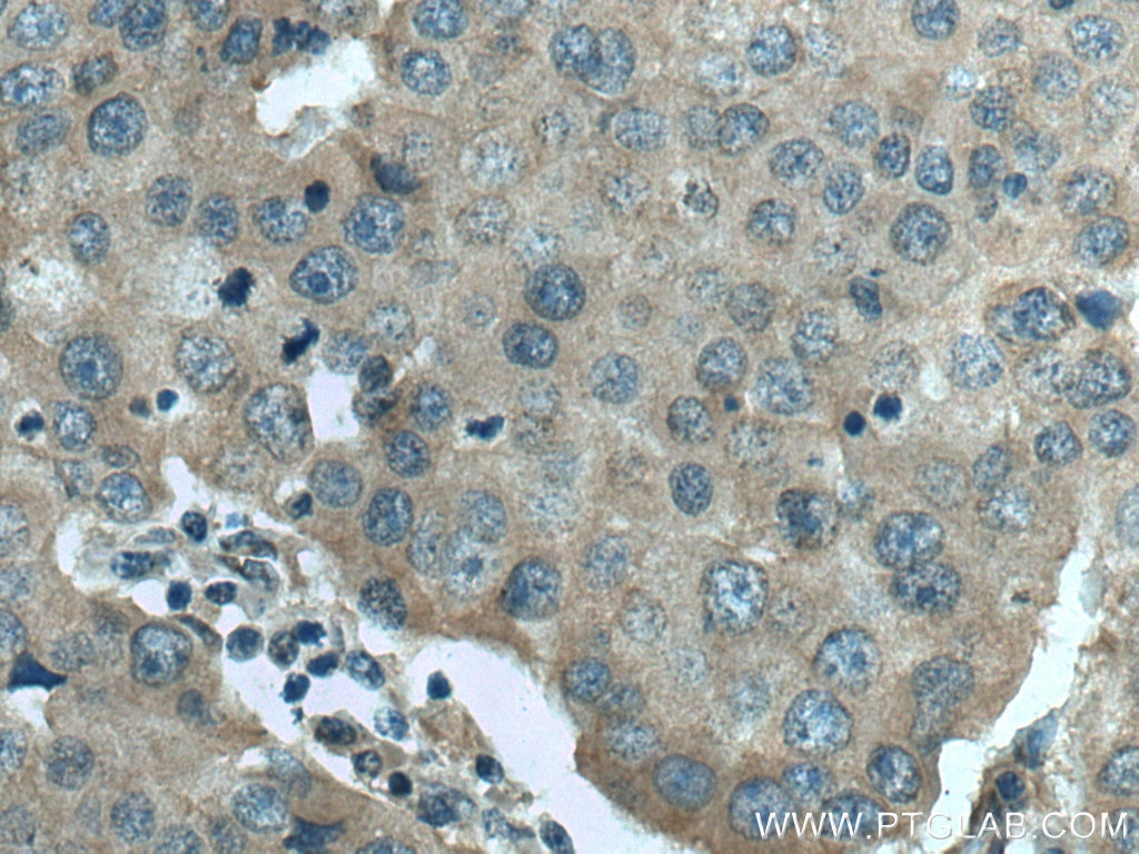 Immunohistochemistry (IHC) staining of human breast cancer tissue using GNAQ Polyclonal antibody (13927-1-AP)