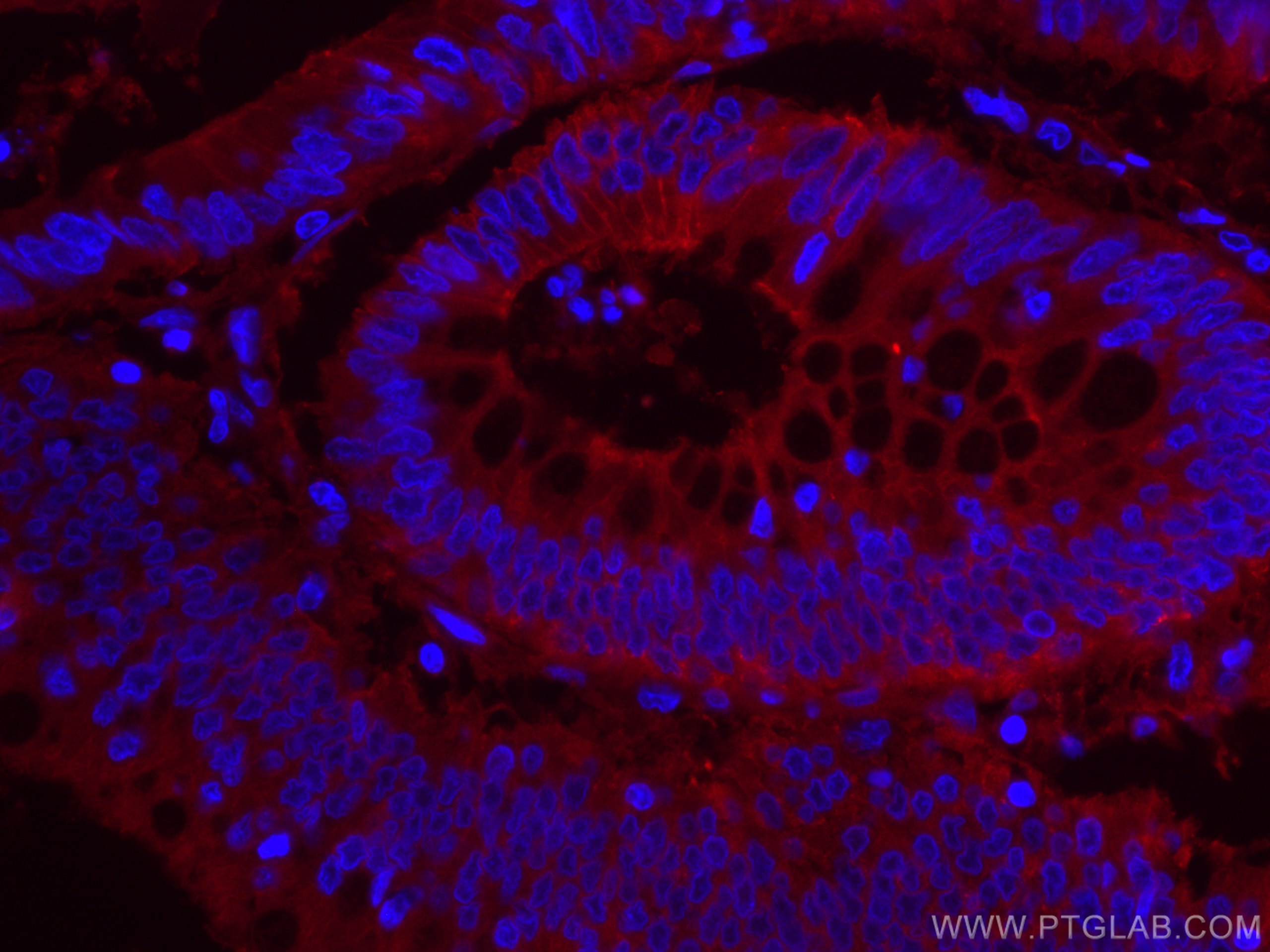 Immunofluorescence (IF) / fluorescent staining of human colon cancer tissue using CoraLite®594-conjugated GNAS Monoclonal antibody (CL594-66253)