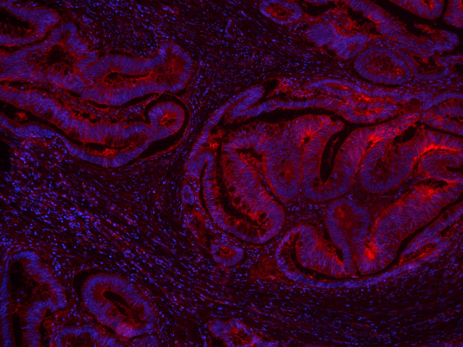 Immunofluorescence (IF) / fluorescent staining of human colon cancer tissue using CoraLite®594-conjugated GNAS Monoclonal antibody (CL594-66253)