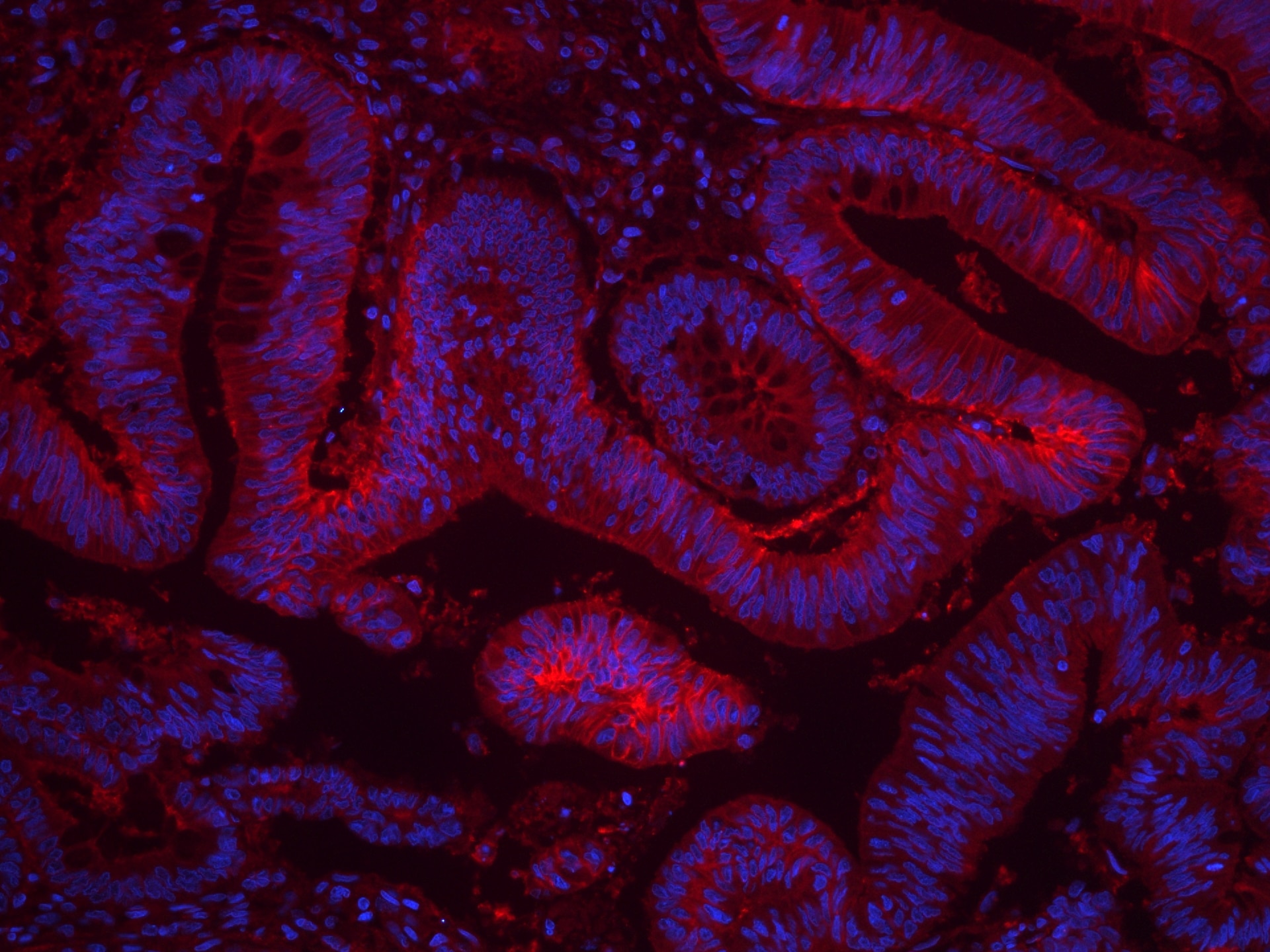 Immunofluorescence (IF) / fluorescent staining of human colon cancer tissue using CoraLite®594-conjugated GNAS Monoclonal antibody (CL594-66253)