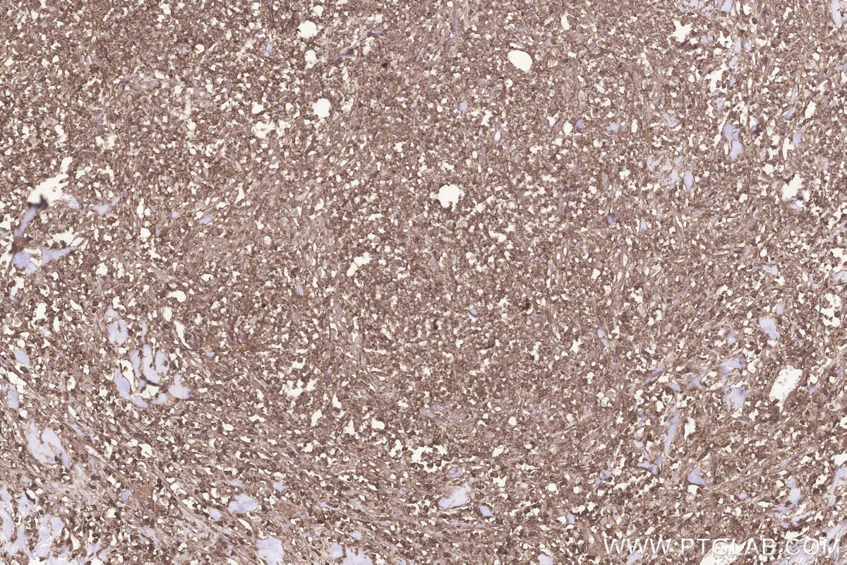 Immunohistochemistry (IHC) staining of human colon cancer tissue using GNB1 Polyclonal antibody (10247-2-AP)