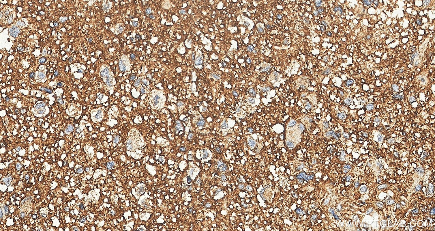 IHC staining of human gliomas using 10247-2-AP (same clone as 10247-2-PBS) Immunohistochemistry (IHC) staining of human gliomas tissue using GNB1 Polyclonal antibody (10247-2-AP)