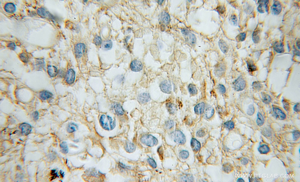 IHC staining of human gliomas using 10247-2-AP