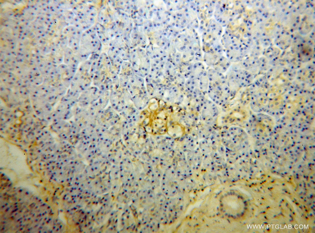 Immunohistochemistry (IHC) staining of human pancreas cancer tissue using GNB1 Polyclonal antibody (10247-2-AP)