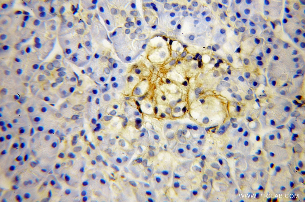 IHC staining of human pancreas cancer using 10247-2-AP