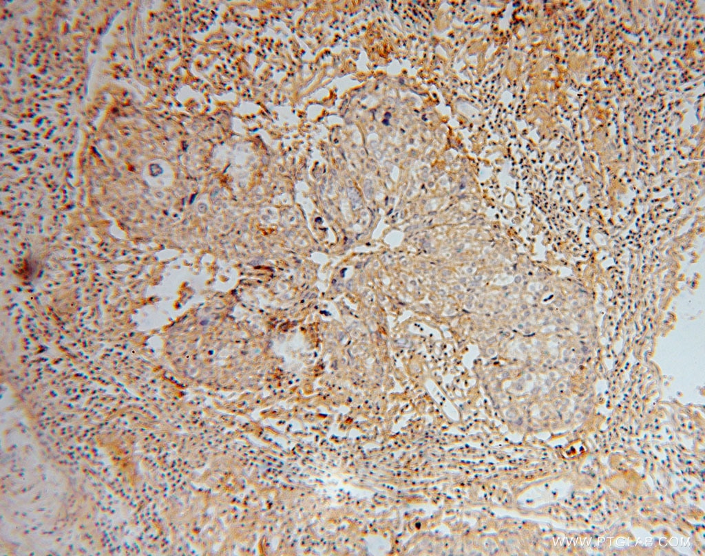 Immunohistochemistry (IHC) staining of human ovary tumor tissue using GNB2 Polyclonal antibody (16090-1-AP)