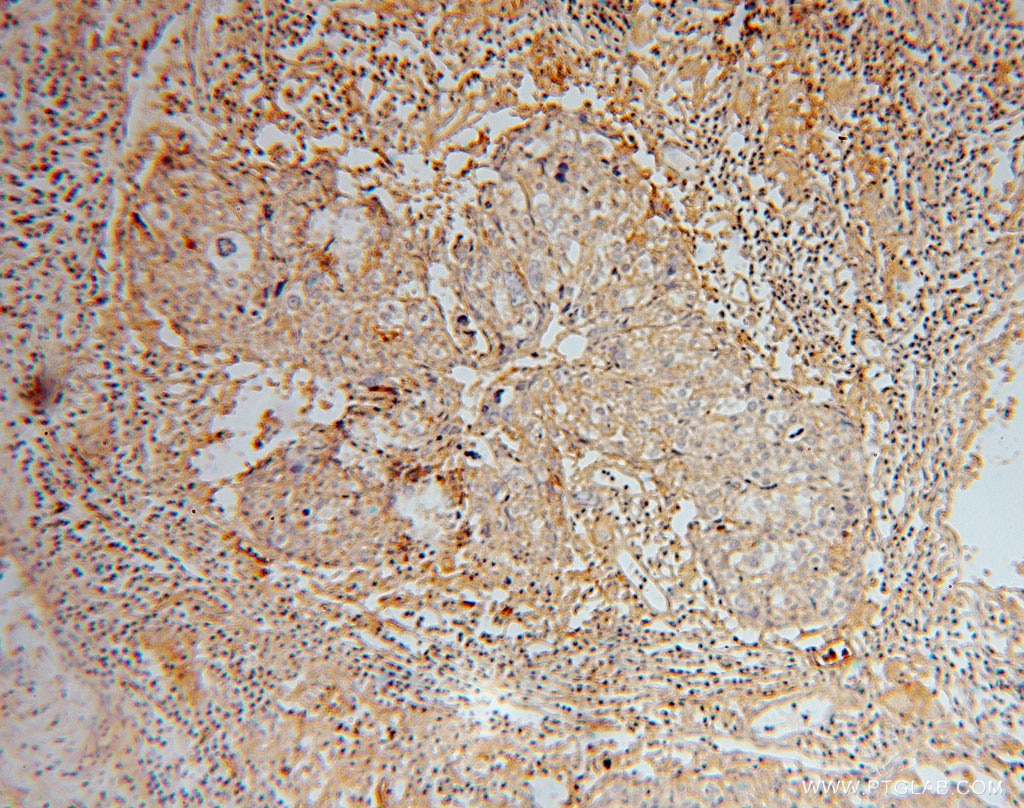 Immunohistochemistry (IHC) staining of human ovary tumor tissue using GNB2 Polyclonal antibody (16090-1-AP)