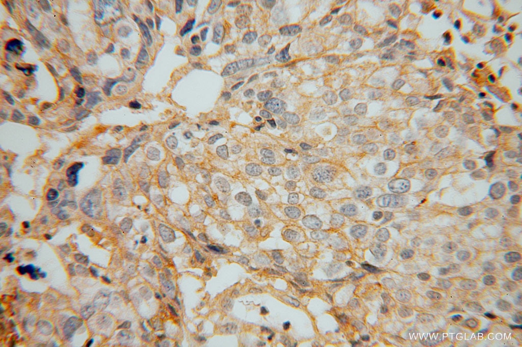Immunohistochemistry (IHC) staining of human ovary tumor tissue using GNB2 Polyclonal antibody (16090-1-AP)