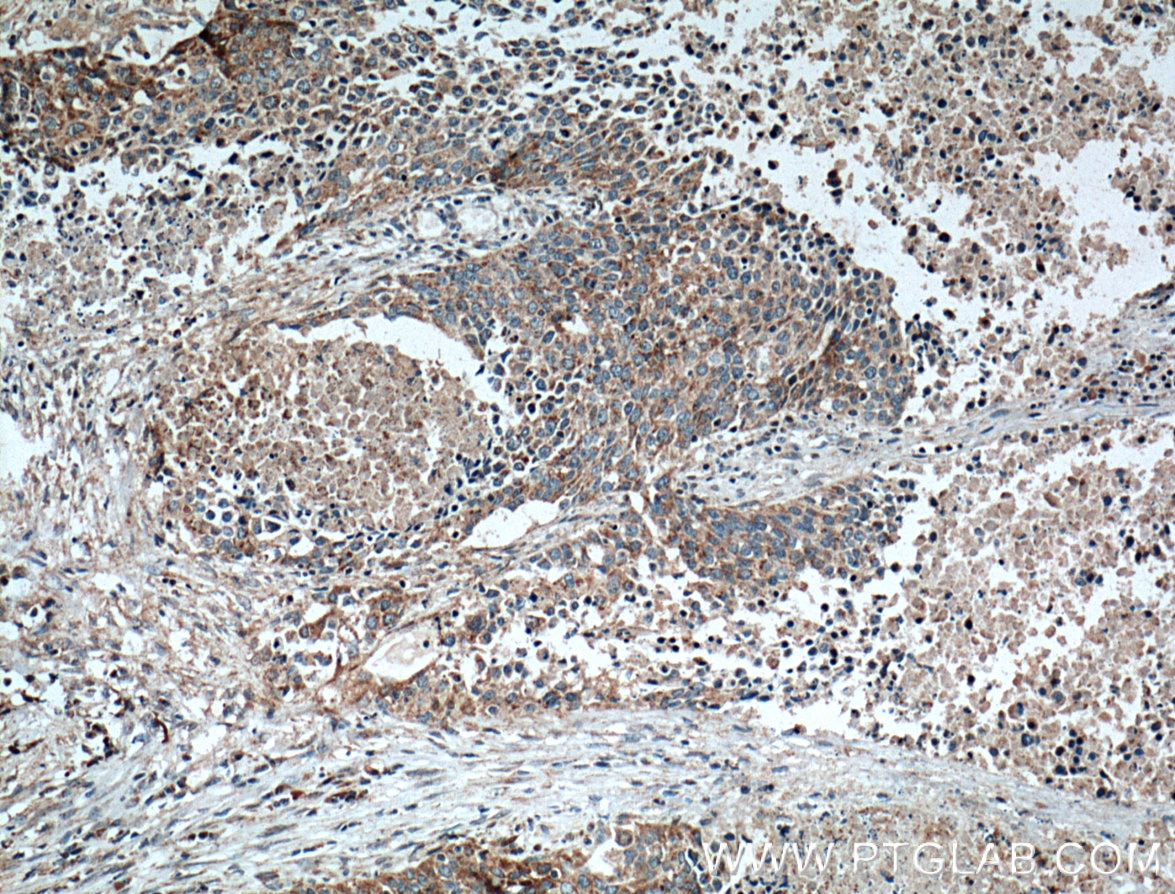 Immunohistochemistry (IHC) staining of human lung cancer tissue using RACK1 Polyclonal antibody (10076-1-AP)