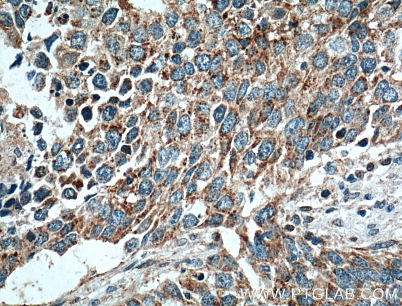 Immunohistochemistry (IHC) staining of human lung cancer tissue using RACK1 Polyclonal antibody (10076-1-AP)