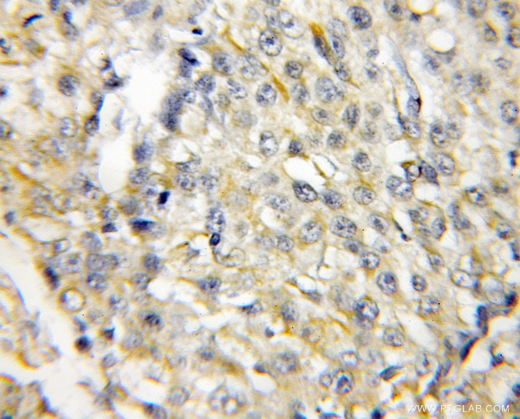 Immunohistochemistry (IHC) staining of human lung cancer tissue using RACK1 Polyclonal antibody (10076-1-AP)