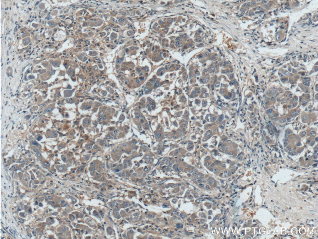 Immunohistochemistry (IHC) staining of human liver cancer tissue using GNB3 Polyclonal antibody (10081-1-AP)