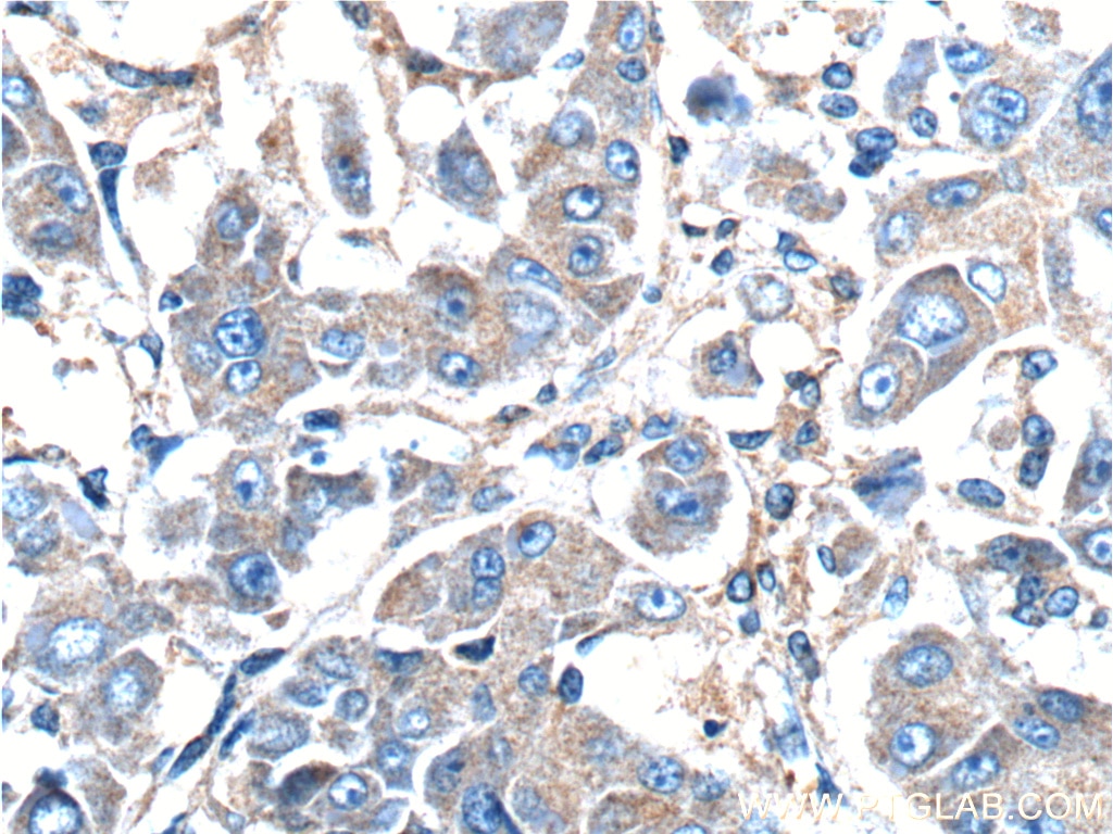 Immunohistochemistry (IHC) staining of human liver cancer tissue using GNB3 Polyclonal antibody (10081-1-AP)