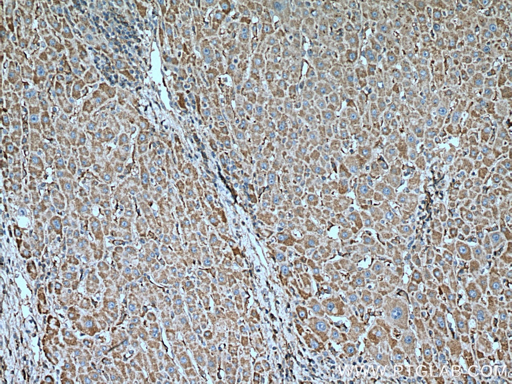 Immunohistochemistry (IHC) staining of human liver cancer tissue using GNB3 Monoclonal antibody (67497-1-Ig)