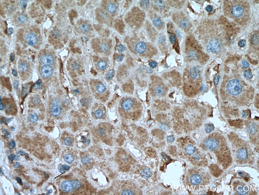 Immunohistochemistry (IHC) staining of human liver cancer tissue using GNB3 Monoclonal antibody (67497-1-Ig)