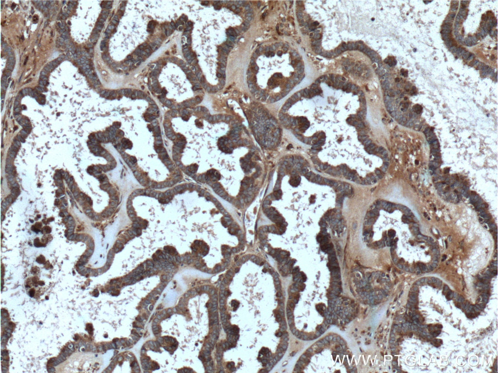 Immunohistochemistry (IHC) staining of human ovary tumor tissue using GNB5 Polyclonal antibody (11045-2-AP)