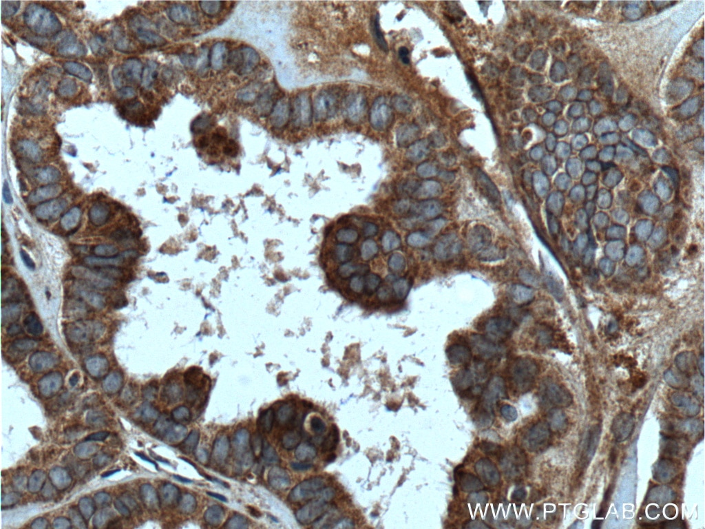 Immunohistochemistry (IHC) staining of human ovary tumor tissue using GNB5 Polyclonal antibody (11045-2-AP)