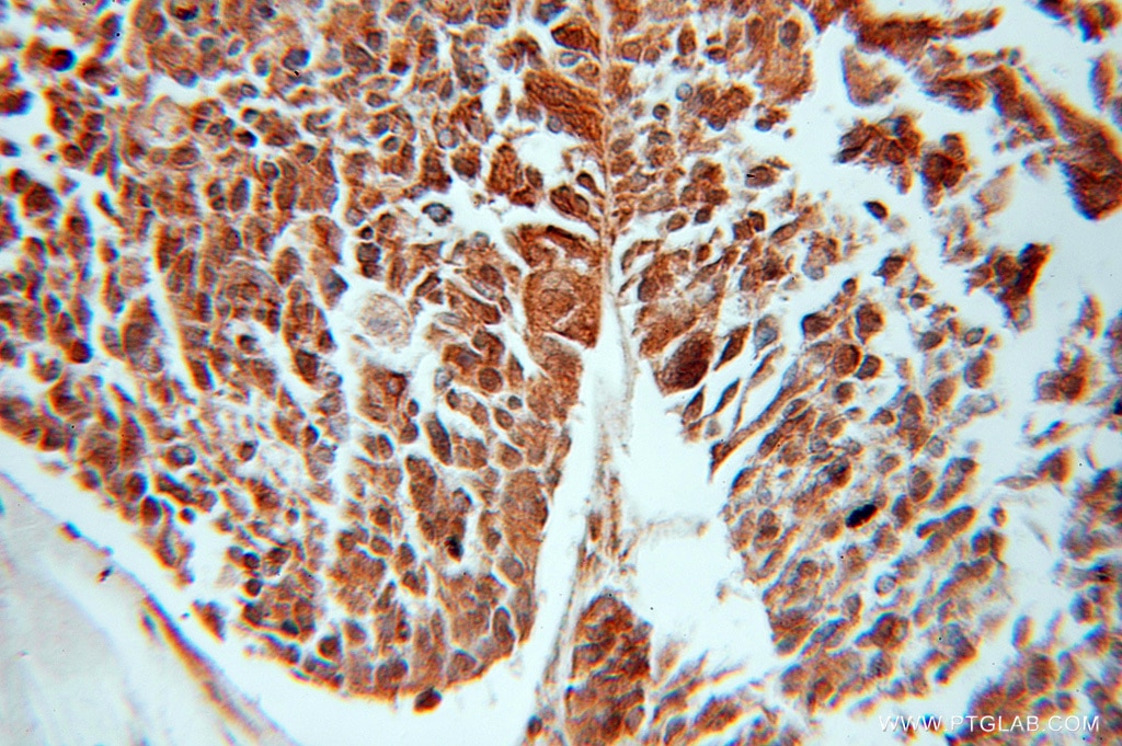 Immunohistochemistry (IHC) staining of human ovary tumor tissue using GNB5 Polyclonal antibody (11045-2-AP)