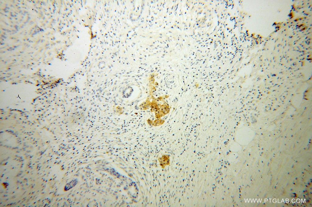 Immunohistochemistry (IHC) staining of human pancreas cancer tissue using GNG4 Polyclonal antibody (13780-1-AP)